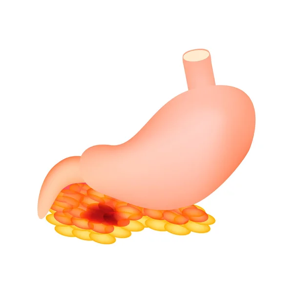 Pancreatite Estrutura Estômago Pâncreas Infográficos Ilustração Vetorial Sobre Fundo Isolado — Vetor de Stock