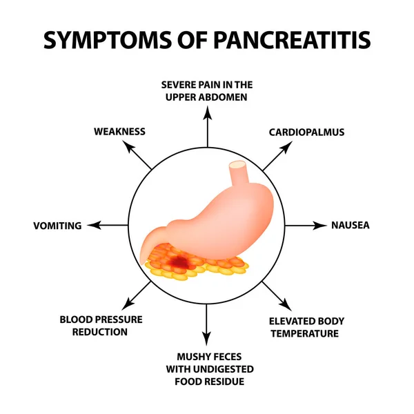 Symptoms Pancreatitis Structure Stomach Pancreas Infographics Vector Illustration Isolated Background — Stock Vector