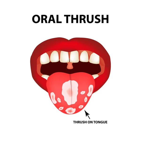 Oral Thrush Candidiasis Tongue Fungus Mouth Infographics Vector Illustration Isolated — Stock Vector