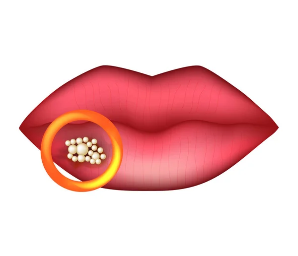 Lippenherpes Infografiken Vektor Illustration Auf Isoliertem Hintergrund — Stockvektor