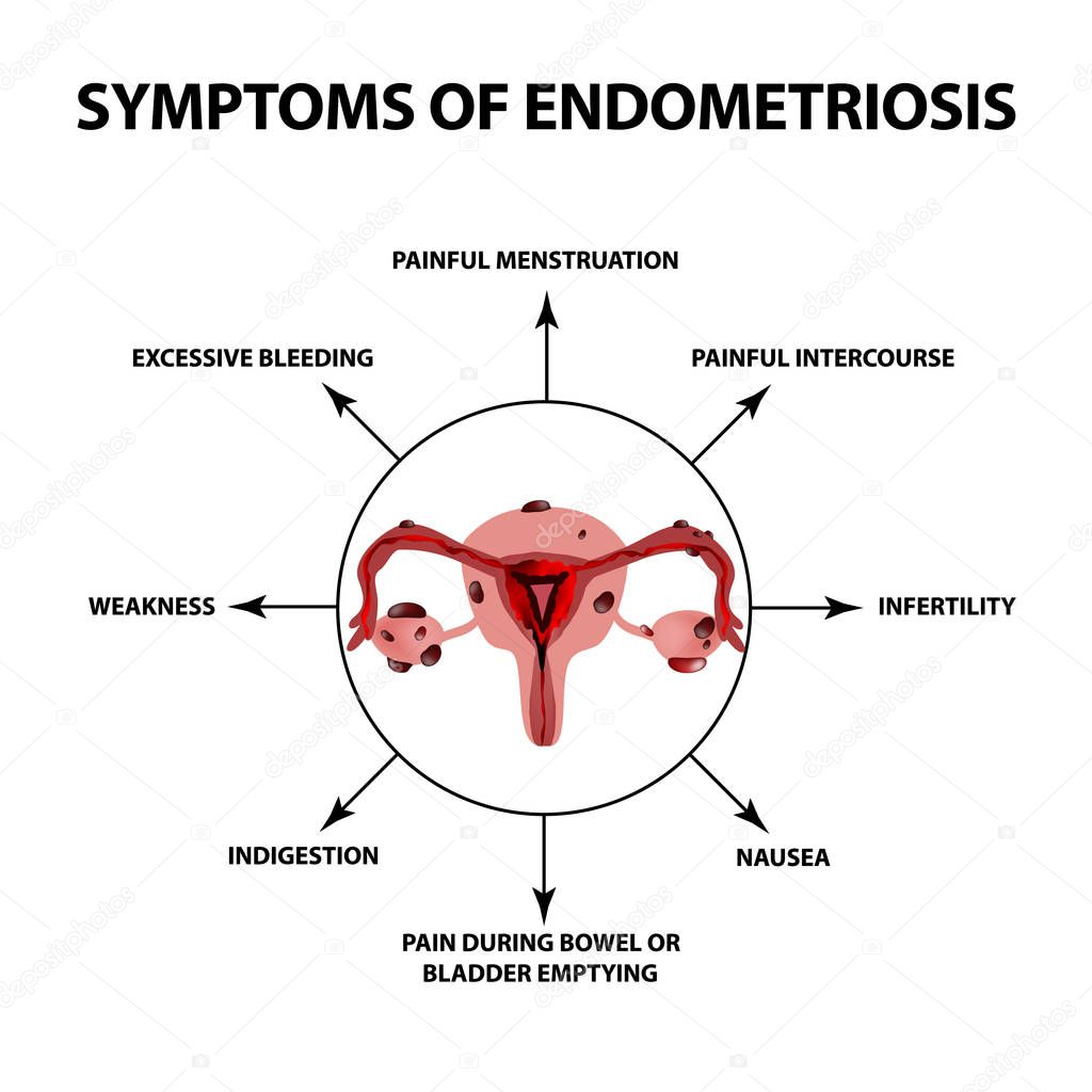 Symptoms of endometriosis. The uterus ovaries structure. Infographics. Vector illustration on isolated background.