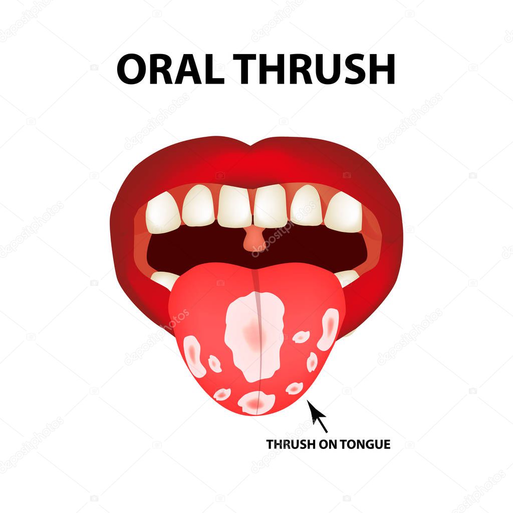 Oral thrush. Candidiasis on the tongue. Fungus in the mouth. Infographics. Vector illustration on isolated background