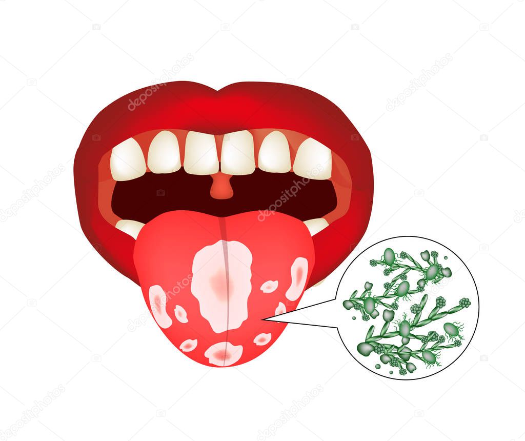 Oral thrush. Candidiasis on the tongue. Fungus in the mouth. Infographics. Vector illustration on isolated background