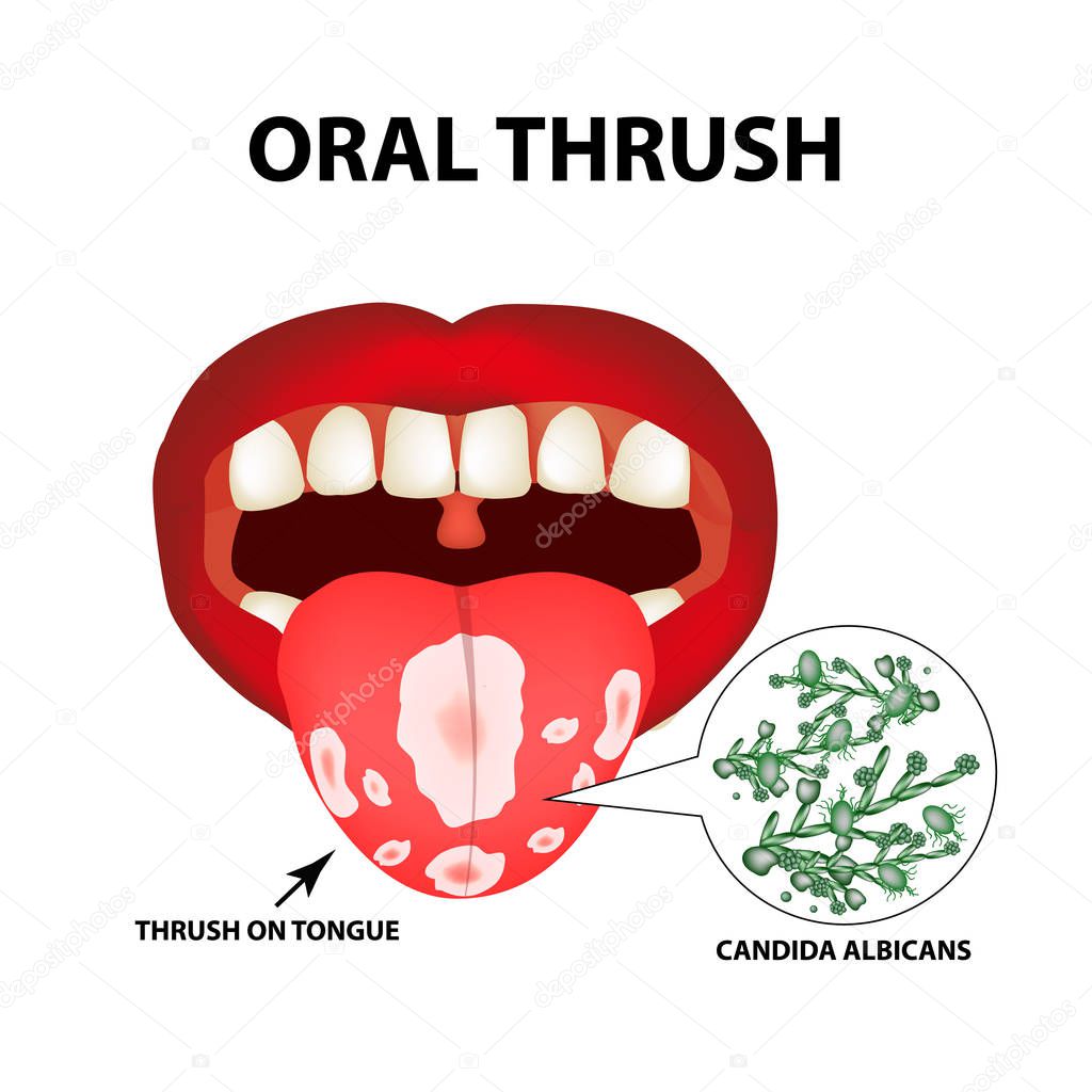 Oral thrush. Candidiasis on the tongue. Fungus in the mouth. Infographics. Vector illustration on isolated background