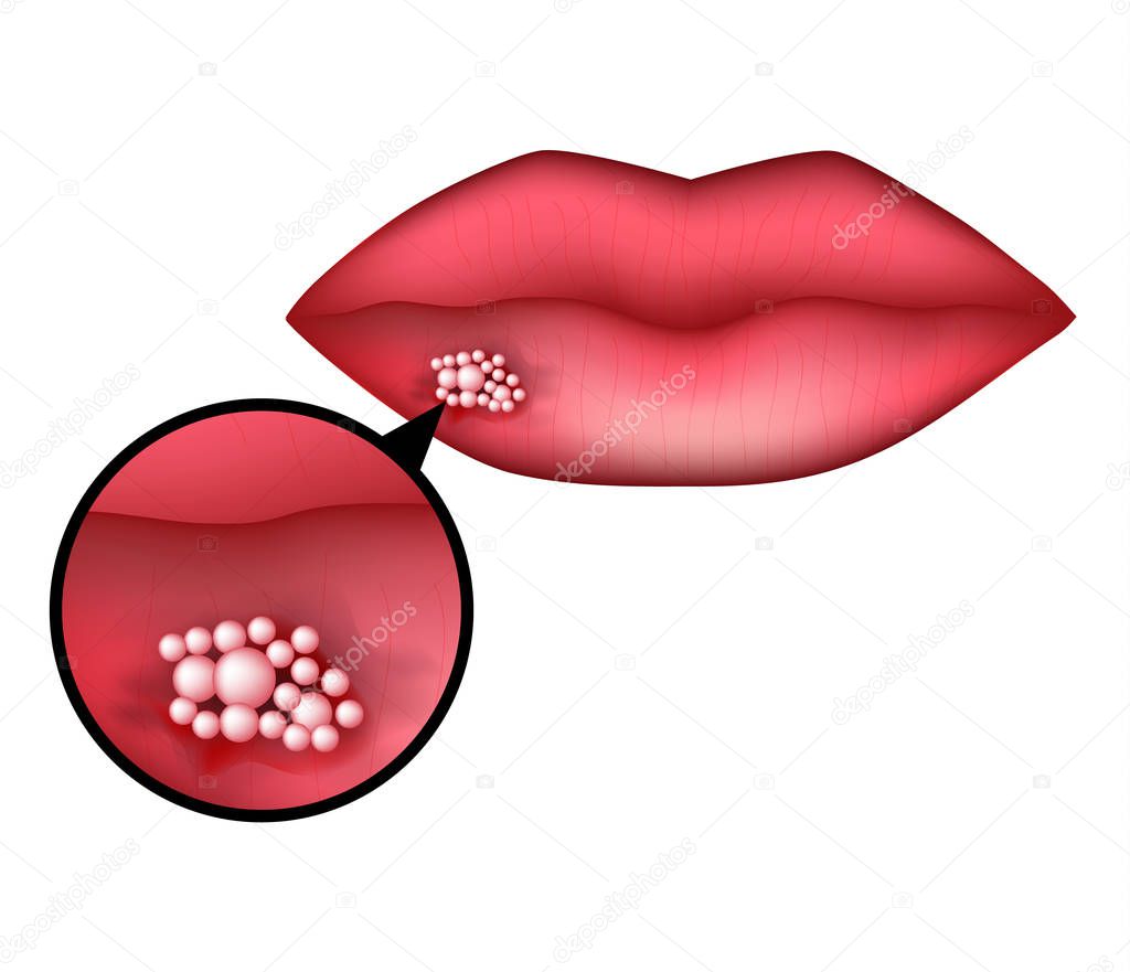 Herpes on the lip. Infographics. Vector illustration on isolated background