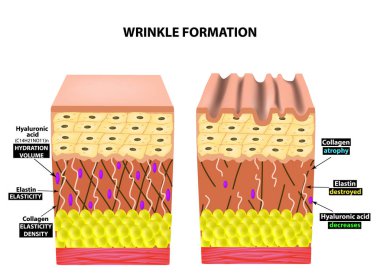 Kırışıklıkların görünümünü. Cildin anatomik yapısı. Elastin, hyaluronik asit, kollajen. Infographics. cilt yaşlanma olayları. Vektör illüstrasyon izole arka plan üzerinde.