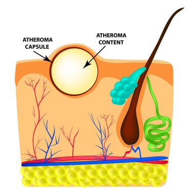 Atheroma structure. The structure of moles on the skin. Infographics. Vector illustration on isolated background clipart