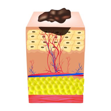 Nevus yapısı. Benler ciltte yapısı. Infographics. Vektör illüstrasyon izole arka plan üzerinde