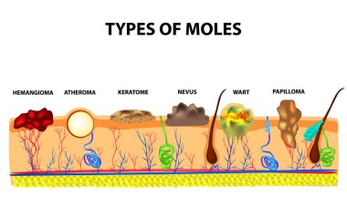 Types of moles. Nevus, pigment spot, papilloma, wart, keratoma, atheroma, hemangeoma. Mole. Anatomical structure of the skin and hair. Infographics Vector illustration on isolated background clipart