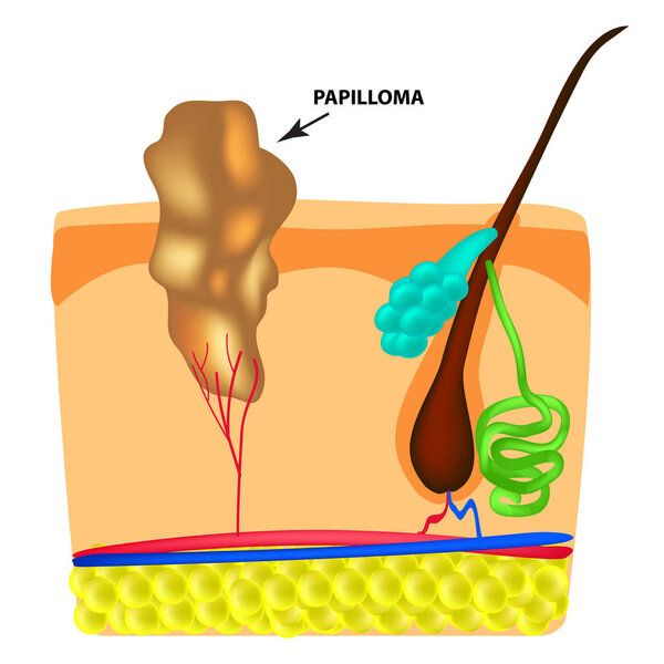 The structure of the papilloma. The structure of the skin. Infographics. Vector illustration on isolated background