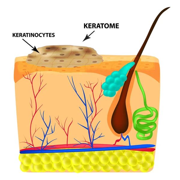Keratoma の構造 角化症 皮膚のほくろの構造 インフォ グラフィック 孤立した背景のベクトル図 — ストックベクタ
