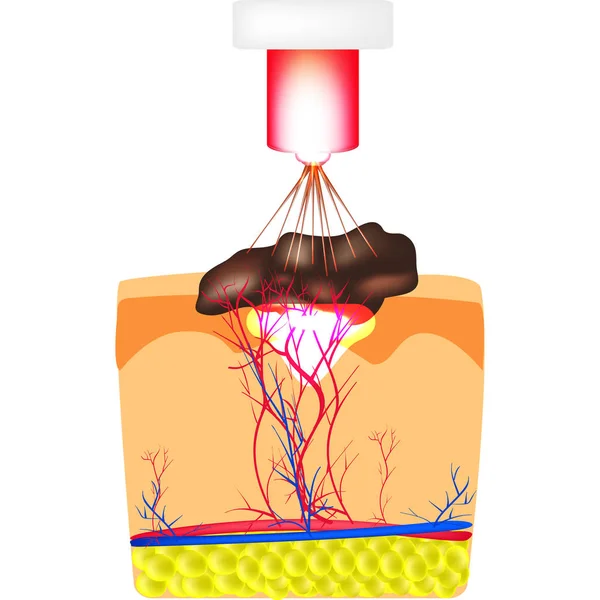 Suppression Des Taches Naissance Popilome Laser Verrue Structure Des Grains — Image vectorielle