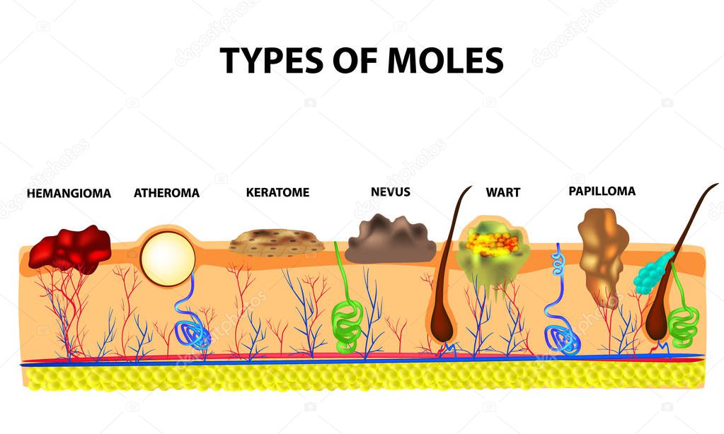 Types of moles. Nevus, pigment spot, papilloma, wart, keratoma, atheroma, hemangeoma. Mole. Anatomical structure of the skin and hair. Infographics Vector illustration on isolated background