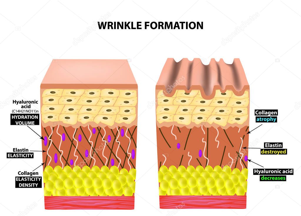 The appearance of wrinkles. Anatomical structure of the skin. Elastin, Hyaluronic acid, Collagen. Infographics. skin aging phenomena. Vector illustration on isolated background.