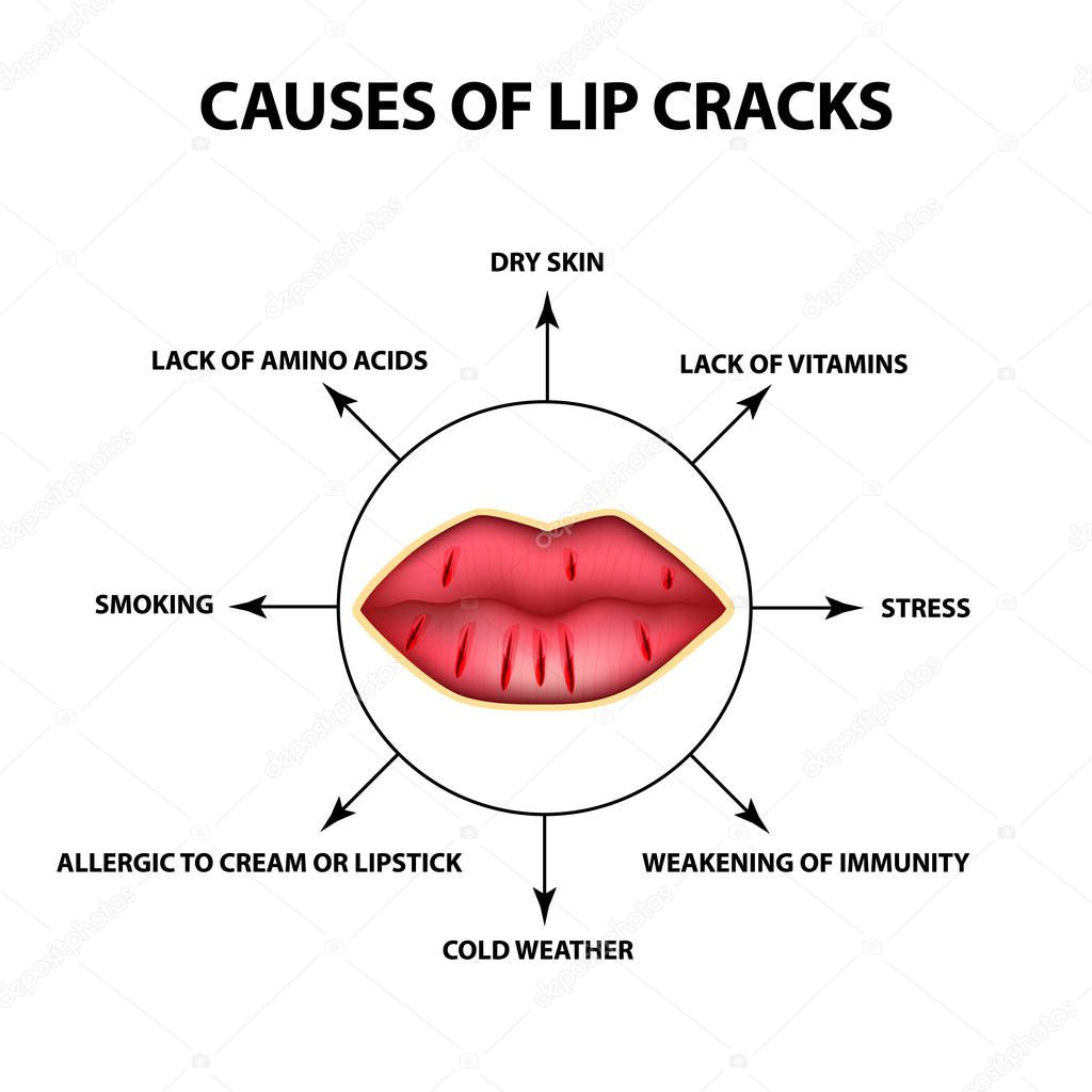 Causes of lip cracks. Cracks in the corners of the mouth. Infographics. Vector illustration on isolated background