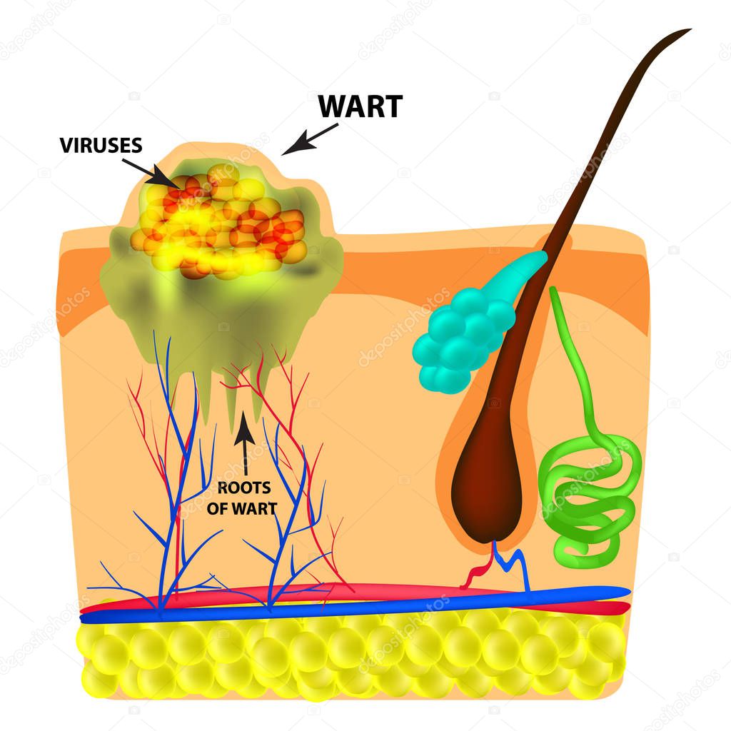The structure of the wart. The structure of the skin. Infographics. Vector illustration on isolated background
