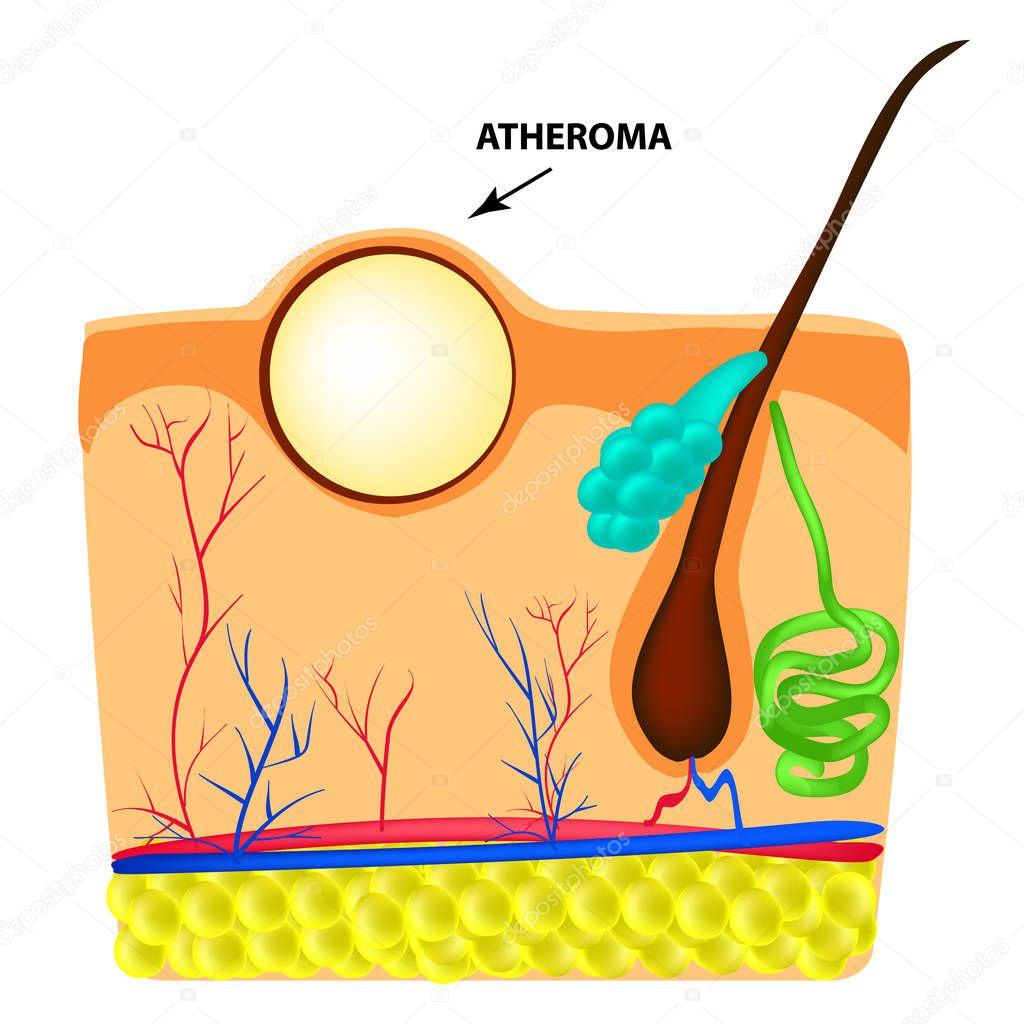 Atheroma structure. The structure of moles on the skin. Infographics. Vector illustration on isolated background
