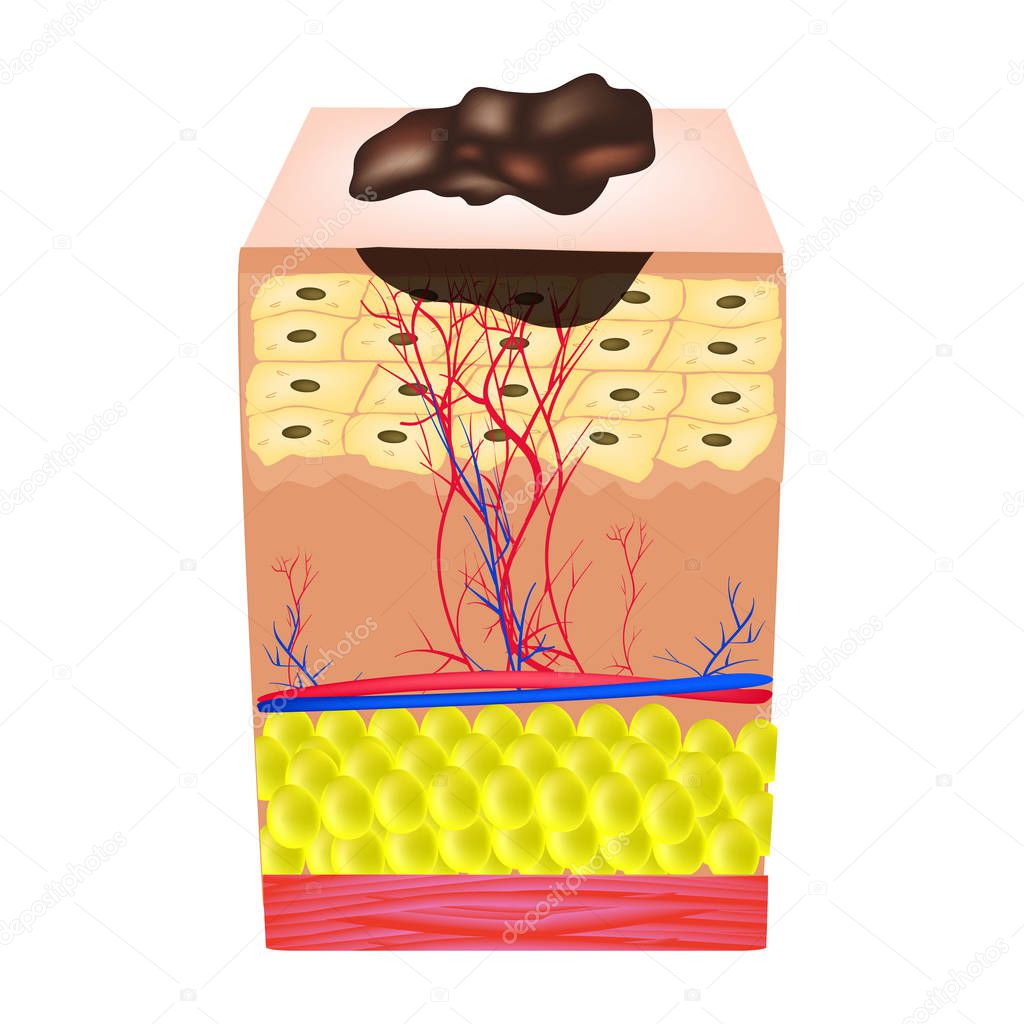 The structure of the nevus. The structure of moles on the skin. Infographics. Vector illustration on isolated background