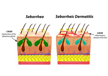 Sebore cilt ve saç neden olur. Kepek Seboreik dermatit. Egzama. Sebasöz Bez fonksiyon bozukluğu. Enflamatuar deri hastalığı. Anatomik yapısı. Infographics. Vektör çizim.