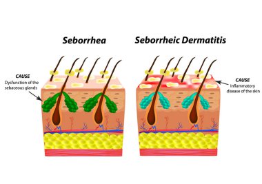 Causes Seborrhea skin and hair. Dandruff seborrheic dermatitis. Eczema. Dysfunction of the sebaceous glands. Inflammatory skin disease. Anatomical structure. Infographics. Vector illustration. clipart