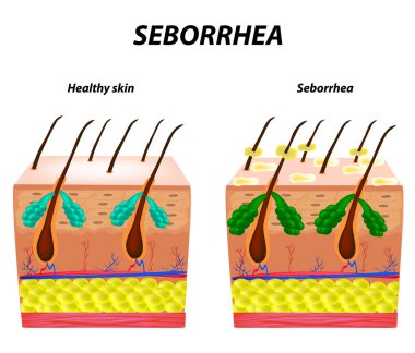 Sebore cilt ve saç. Kepek Seboreik dermatit. Egzama. Sebasöz Bez fonksiyon bozukluğu. Enflamatuar deri hastalığı. Anatomik yapısı. Infographics. Vektör çizim