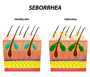 Seborrhea skin and hair. Dandruff seborrheic dermatitis. Eczema. Dysfunction of the sebaceous glands. Inflammatory skin disease. Anatomical structure. Infographics. Vector illustration clipart