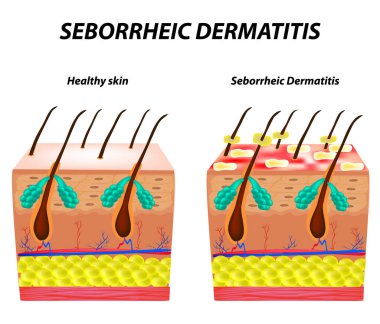 Seborrhea skin and hair. Dandruff seborrheic dermatitis. Eczema. Dysfunction of the sebaceous glands. Inflammatory skin disease. Anatomical structure. Infographics. Vector illustration clipart