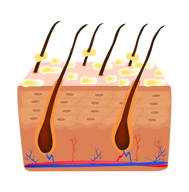 Sebore cilt ve saç. Kepek Seboreik dermatit. Sebasöz Bez fonksiyon bozukluğu. Enflamatuar deri hastalığı. Anatomik yapısı. Infographics. Vektör illüstrasyon izole arka plan üzerinde