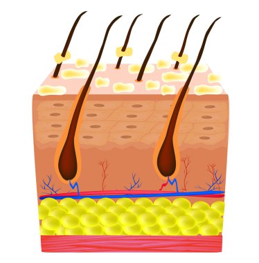 Sebore cilt ve saç. Kepek Seboreik dermatit. Sebasöz Bez fonksiyon bozukluğu. Enflamatuar deri hastalığı. Anatomik yapısı. Infographics. Vektör illüstrasyon izole arka plan üzerinde