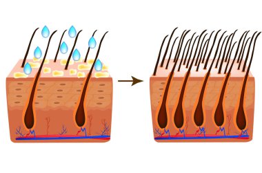 Alopesi tedavisinde. Vitaminler saç. Biotin. Sebore cilt ve saç. Kepek, Seboreik dermatit. Kellik, saç büyüme, kellik anatomik yapısı Infographics vektör çizim