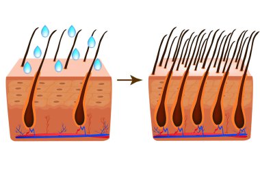 Alopesi tedavisinde. Vitaminler saç. Biotin. Sebore cilt ve saç. Kepek, Seboreik dermatit. Kellik, saç büyüme, kellik anatomik yapısı Infographics vektör çizim
