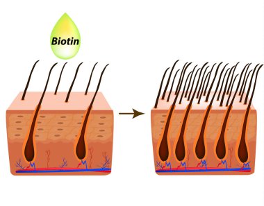 Alopesi tedavisinde. Vitaminler saç. Biotin. Sebore cilt ve saç. Kepek, Seboreik dermatit. Kellik, saç büyüme, kellik anatomik yapısı Infographics vektör çizim