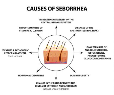 Causes of seborrhea. Seborrhea skin and hair. Dandruff, seborrheic dermatitis. Baldness, hair growth, baldness. Anatomical structure. Infographics. Vector illustration on isolated background clipart