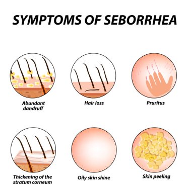 Symptoms of seborrhea. Seborrhea skin and hair. Dandruff, seborrheic dermatitis. Baldness, hair growth, baldness. Anatomical structure. Infographics. Vector illustration on isolated background clipart