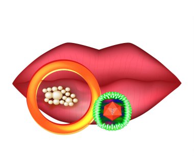 Herpes virüsü dudak üzerinde. Herpes anatomik yapısını. Infographics. Vektör illüstrasyon izole arka plan üzerinde