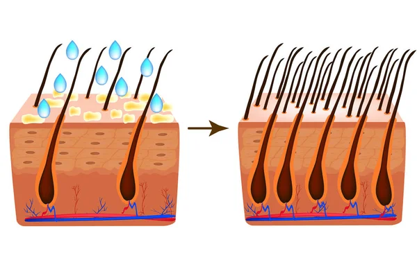 Alopesi tedavisinde. Vitaminler saç. Biotin. Sebore cilt ve saç. Kepek, Seboreik dermatit. Kellik, saç büyüme, kellik anatomik yapısı Infographics vektör çizim