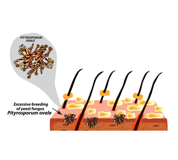 酵母真菌病原体脂漏ピチロスポルム属卵癜風菌 脂漏肌と髪 脂漏性皮膚炎 解剖学的構造 インフォ グラフィック ベクトル図 — ストックベクタ