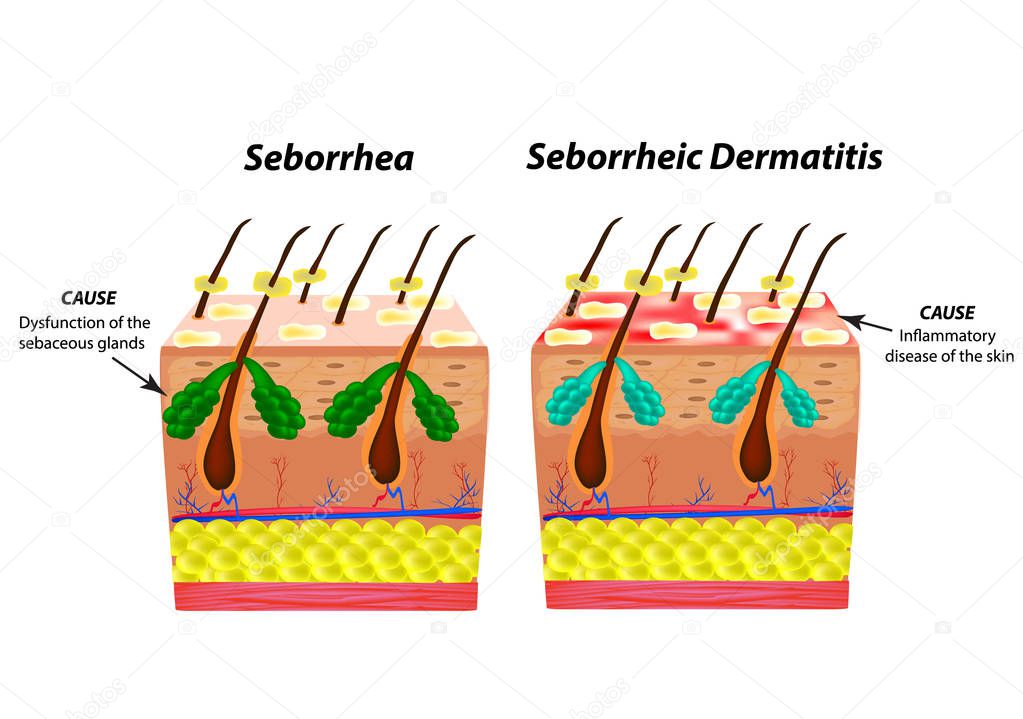 Causes Seborrhea skin and hair. Dandruff seborrheic dermatitis. Eczema. Dysfunction of the sebaceous glands. Inflammatory skin disease. Anatomical structure. Infographics. Vector illustration.