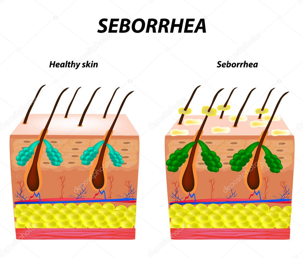 Seborrhea skin and hair. Dandruff seborrheic dermatitis. Eczema. Dysfunction of the sebaceous glands. Inflammatory skin disease. Anatomical structure. Infographics. Vector illustration