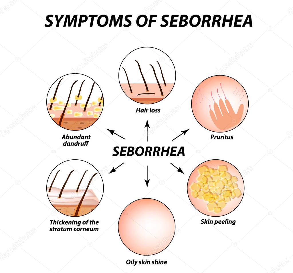 Symptoms of seborrhea. Seborrhea skin and hair. Dandruff, seborrheic dermatitis. Baldness, hair growth, baldness. Anatomical structure. Infographics. Vector illustration on isolated background