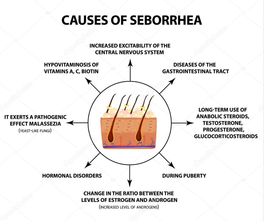 Causes of seborrhea. Seborrhea skin and hair. Dandruff, seborrheic dermatitis. Baldness, hair growth, baldness. Anatomical structure. Infographics. Vector illustration on isolated background