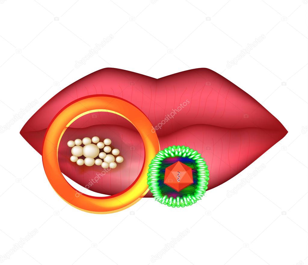 Herpes virus on the lip. Anatomical structure of herpes. Infographics. Vector illustration on isolated background