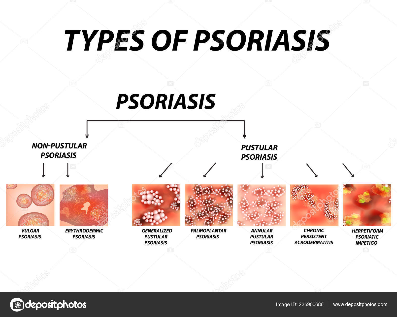 psoriasis eritrodermica)