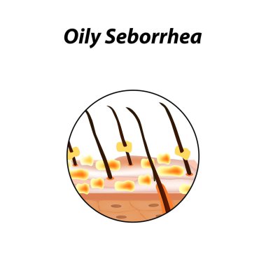 Cilt ve saç yağlı seborrhea. Kepek, Seboreik dermatit. Kellik, saç büyüme, kellik. Anatomik yapısı. Infographics. Vektör illüstrasyon izole arka plan üzerinde