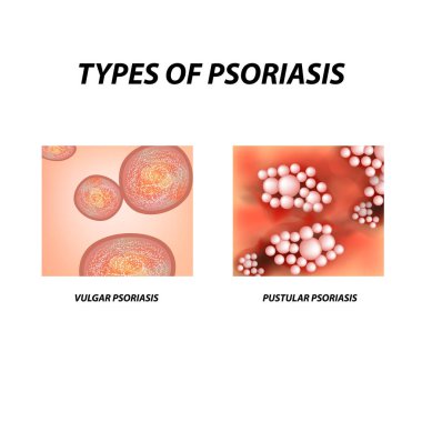 Types of psoriasis. Not pustular and pustular psoriasis. Eczema, skin disease dermatitis. Infographics. Vector illustration on isolated background clipart