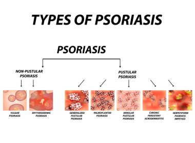 Types of psoriasis. Pustular and not pustular. Vulgar, erythroderma, erythrodermic psoriasis, persistent acrodermatitis, psoriatic impetigo. Eczema, skin disease dermatitis. Infographics. Vector illustration on isolated background clipart