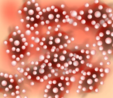 Palmoplantar sedef doku. Egzama Dermatit deri hastalığı sedef. Infographics. Vektör çizim