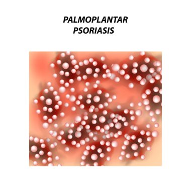 Palmoplantic sedef. Egzama Dermatit deri hastalığı sedef. Infographics. Vektör illüstrasyon izole arka plan üzerinde