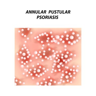 Anüler Püstüler Psoriyazis. Egzama Dermatit deri hastalığı sedef. Infographics. Vektör illüstrasyon izole arka plan üzerinde