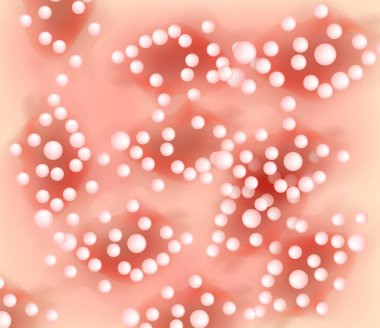 Annuly Püstüler psoriasis doku. Egzama Dermatit deri hastalığı sedef. Infographics. Vektör çizim